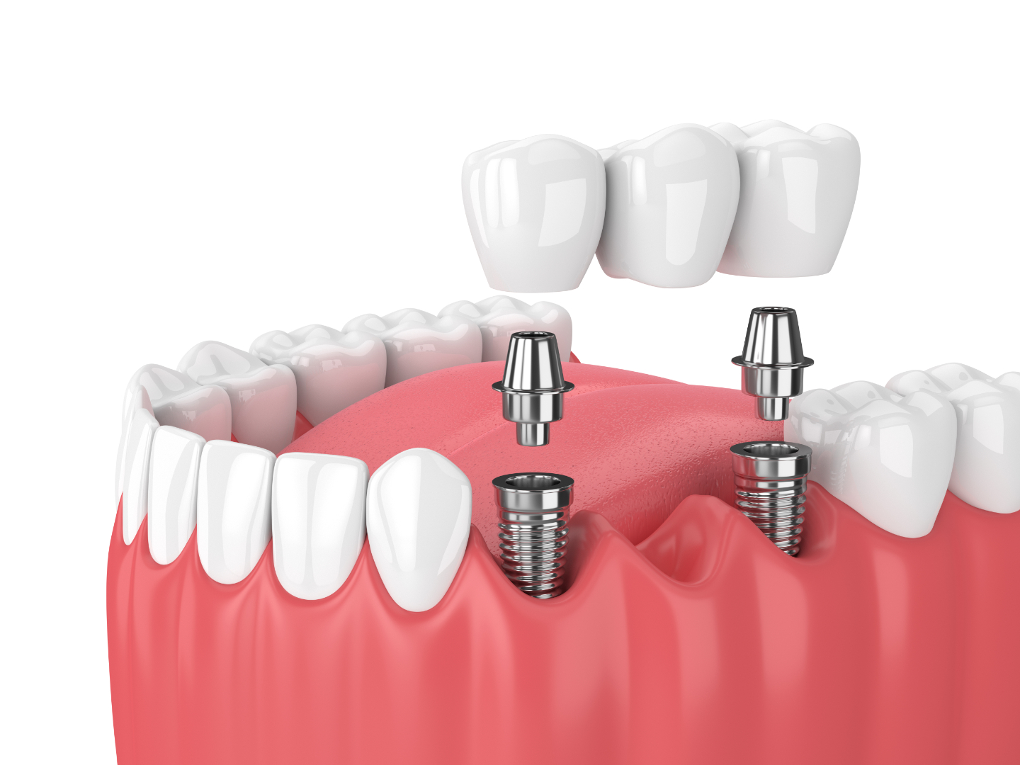 Unlocking Personalised Nutrition for Optimal Dental Implant Health